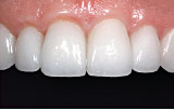 Excessive tooth wear after