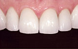 Moderate tooth wear after