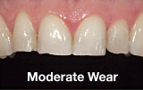Moderate tooth wear before